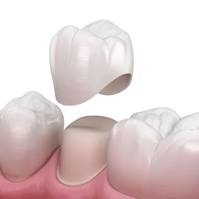 Zirconium dental crown being fitted on a tooth