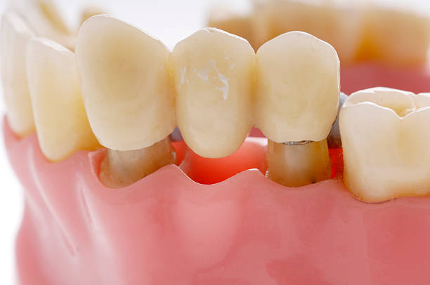Close-up of a three-tooth bridge fixed onto supporting teeth on a dental model