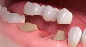 Illustration of a bridge above a gap, with the prepared teeth on either side that will support it