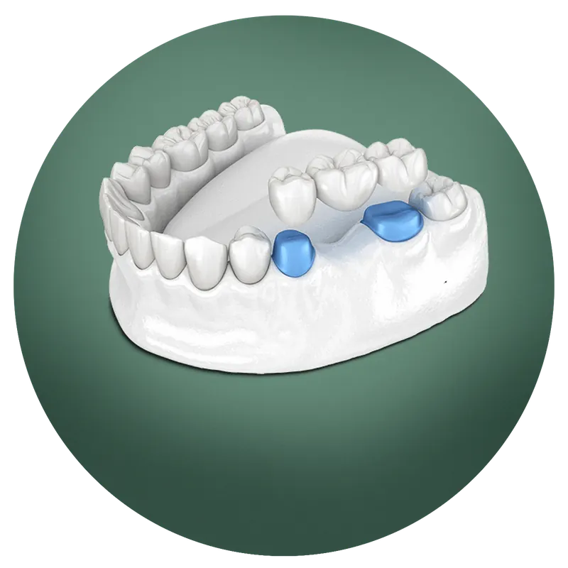 Illustration of a three-tooth bridge being placed over two prepared teeth on a lower jaw model