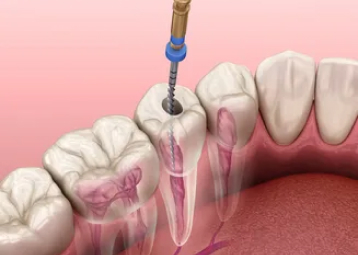 Illustration of a dental file placed into a lower back tooth to clean its root canals