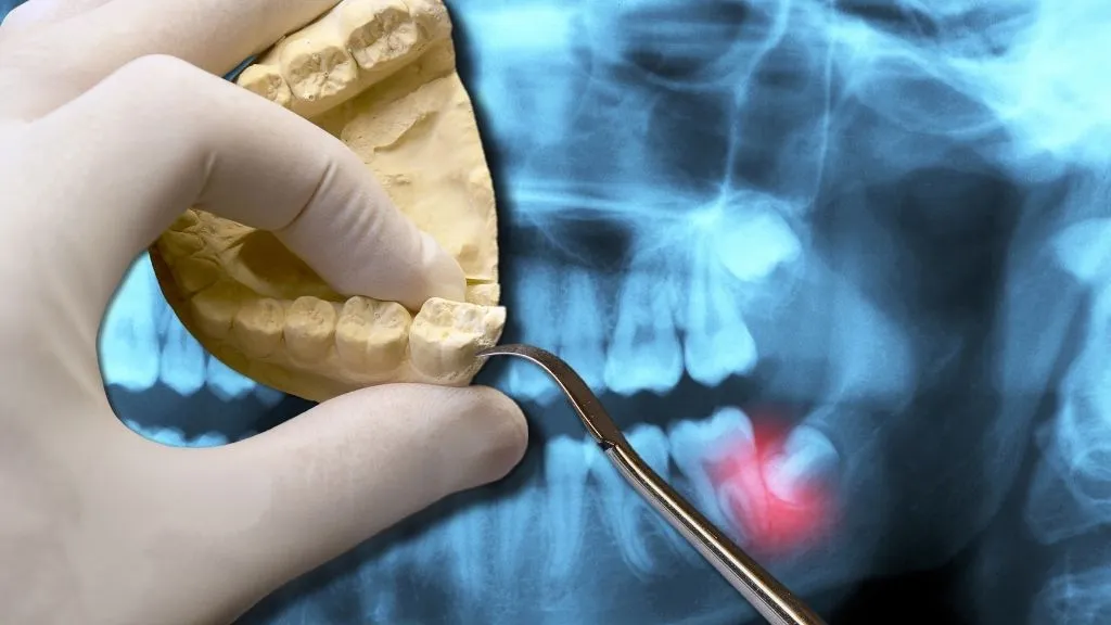 A gloved hand holding a dental model and probe in front of an X-ray with a wisdom tooth highlighted in red