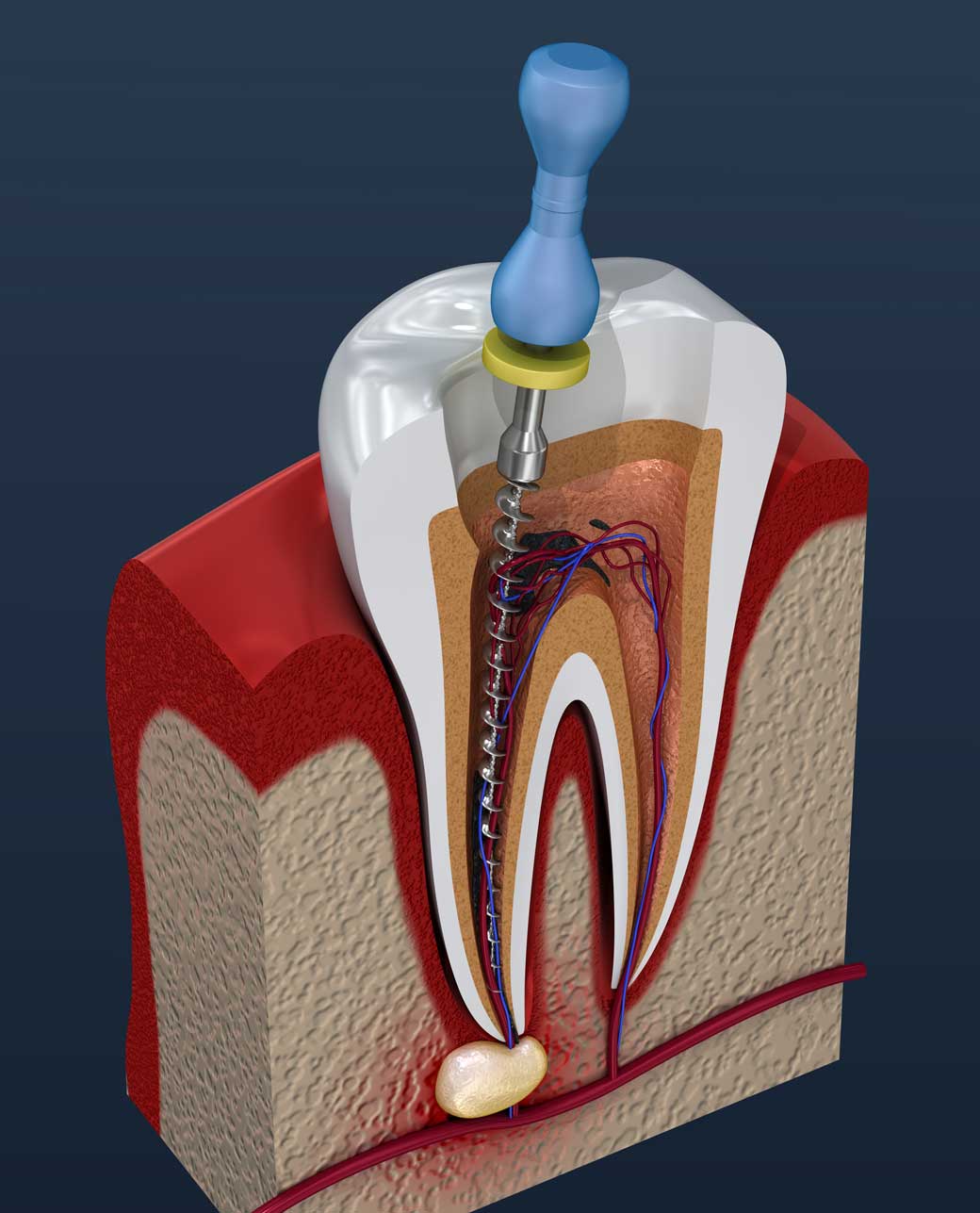 Illustrated cross-section of a molar with a root canal file cleaning the infected pulp and an infection at the root tip